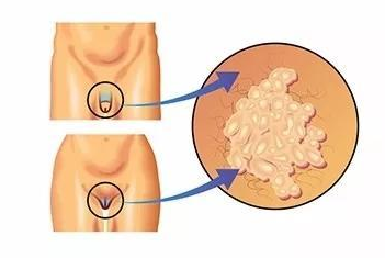 生殖器有白色豆腐渣？(图1)